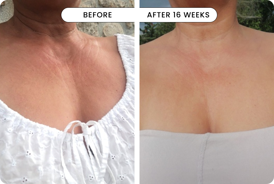 result Neck & Décolletage LED Device