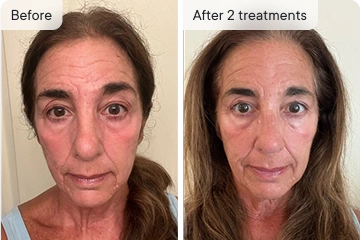 HoMEso Customer before and after results