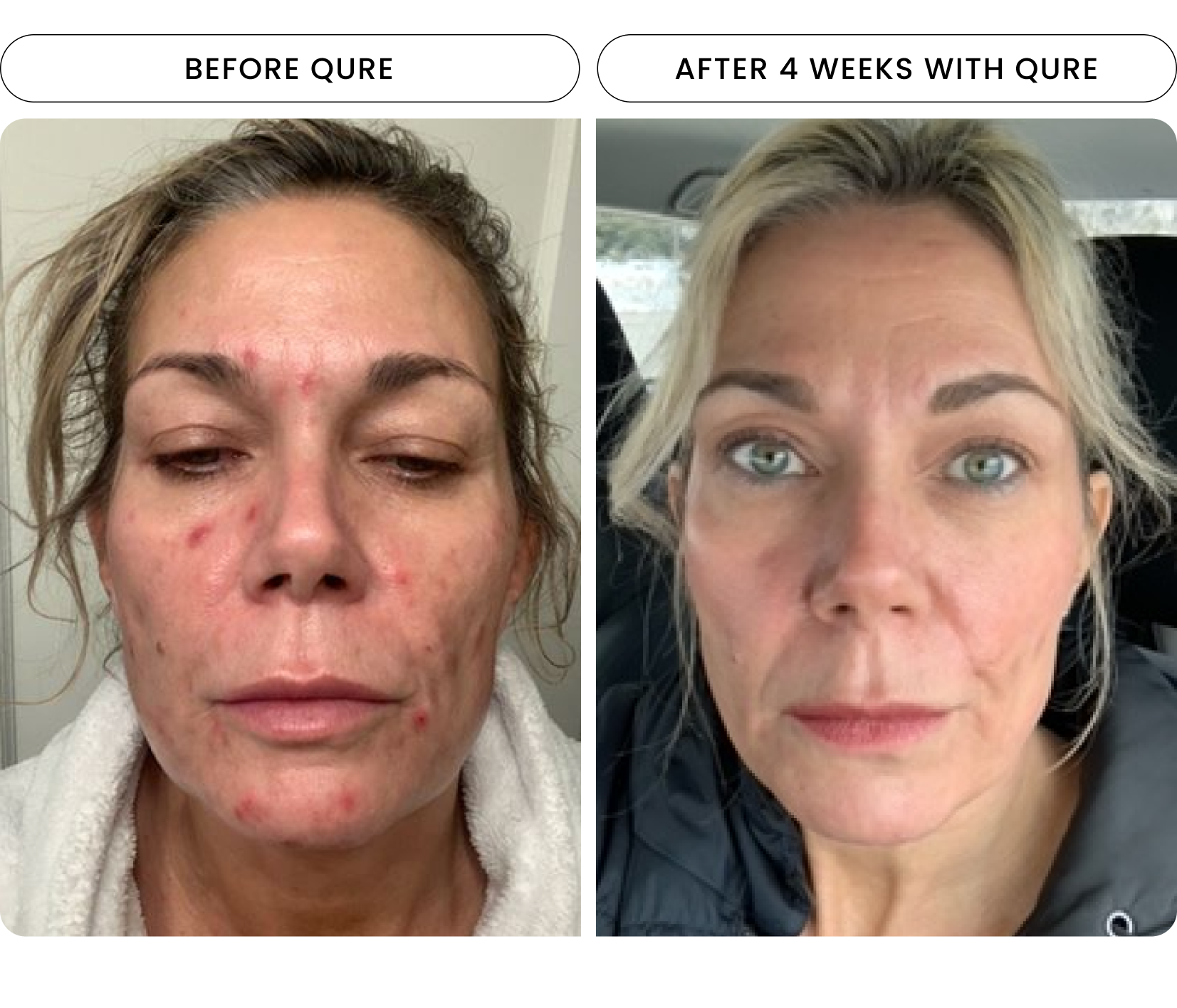 Red Light Mask | Rejuvenating LED Light Therapy | Qure