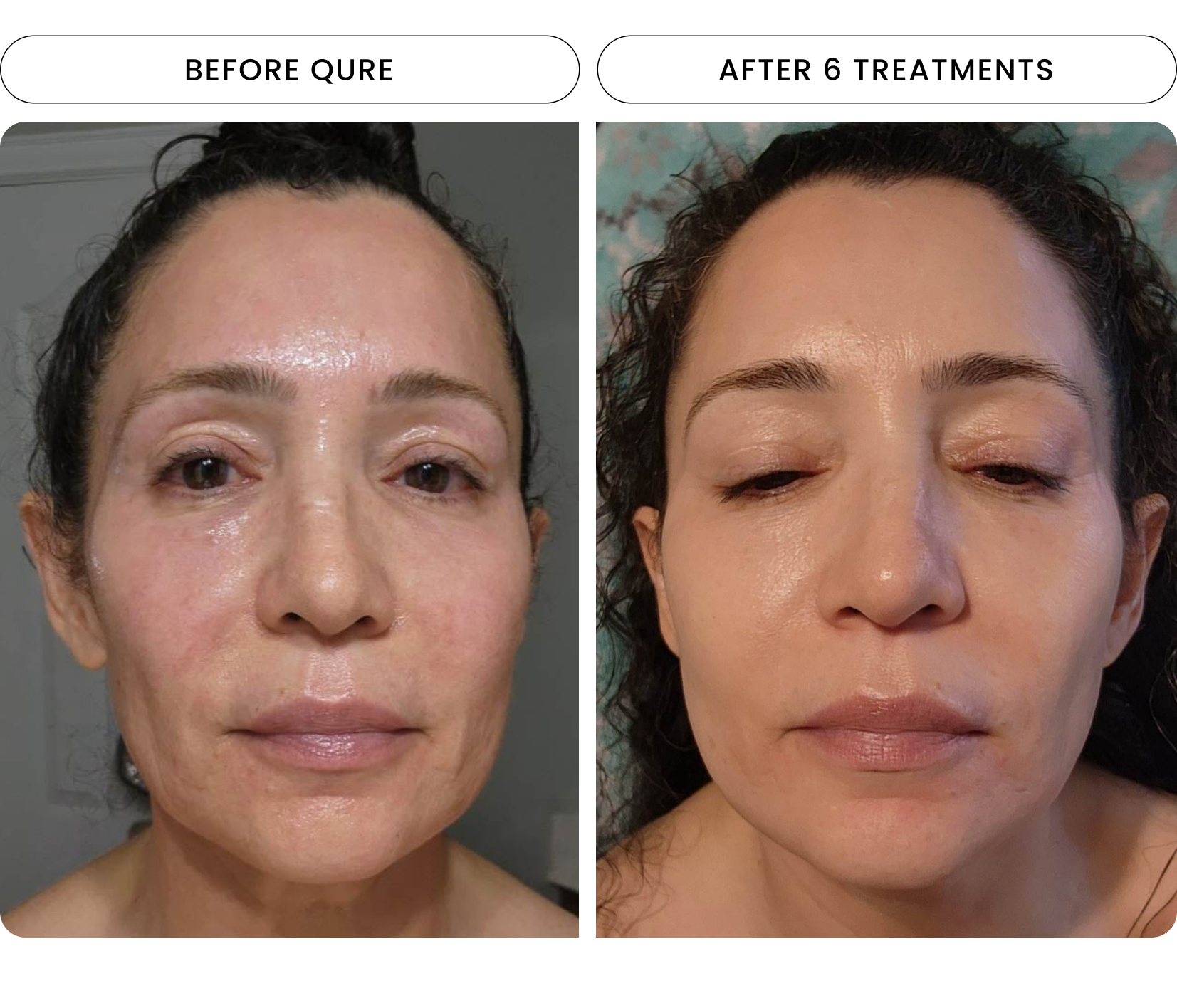 renovae micro infusion system recensioni
