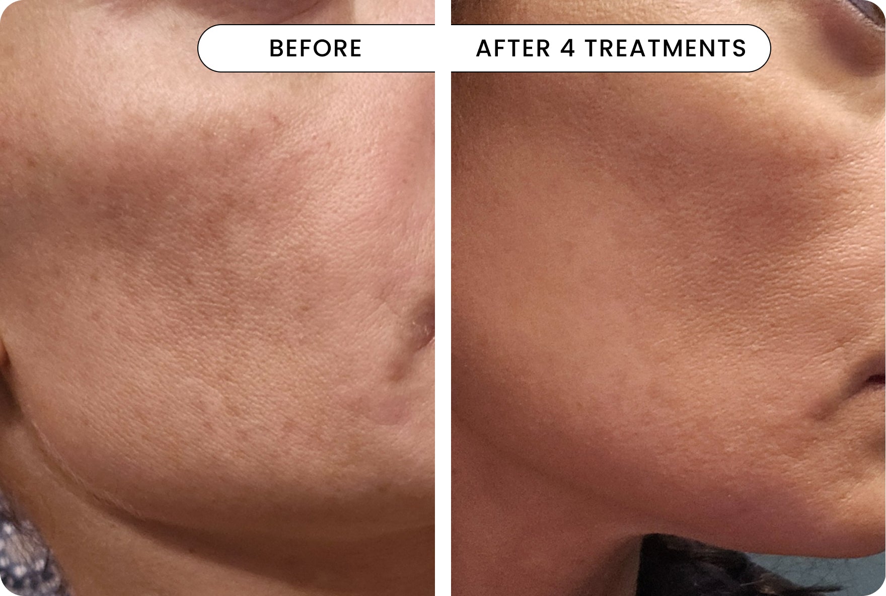 result Micro-Infusion 3 Month Bundle (For Dark Spots) (Pre-Order)