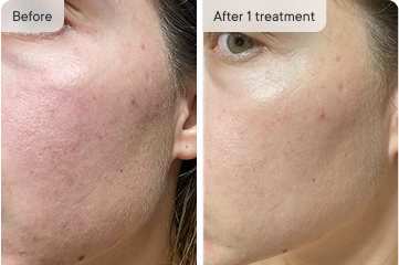HoMEso Customer before and after results