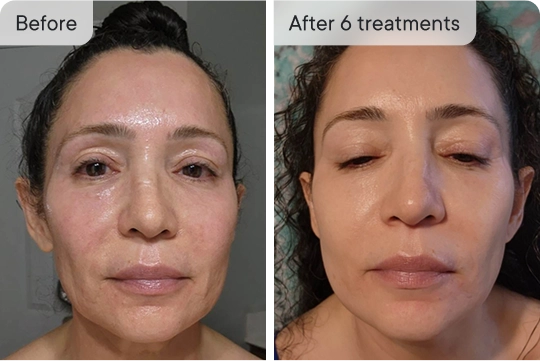 HoMEso Customer before and after results