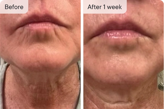 Jennifer's neck and chin before & after 1 week, showing wrinkle reduction.