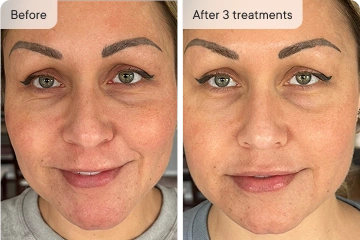 HoMEso Customer before and after results