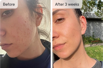 Josie's acne before & after 3 weeks, showing improved skin.