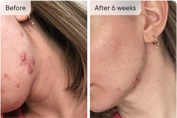 Before & After 6 weeks