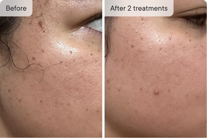 Kyla's skin before and after 2 treatments