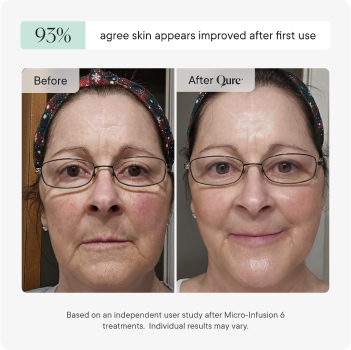 Micro-Infusion 3 Month Bundle (For Wrinkles)