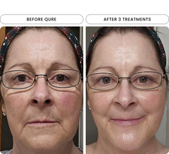 Micro-Infusion 3 Month Bundle (For Wrinkles)