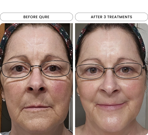 Micro-Infusion 3 Month Bundle (For Wrinkles)