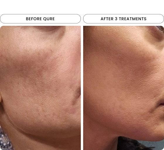 Micro-Infusion 3 Month Bundle (For Wrinkles + Dark Spots)