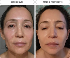 Micro-Infusion 6 Month Bundle (For Wrinkles + Dark Spots)