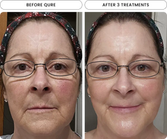 Micro-Infusion 6 Month Bundle (For Dark Spots)