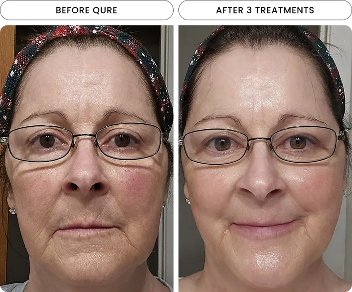 Micro-Infusion 6 Month Bundle (For Dark Spots)