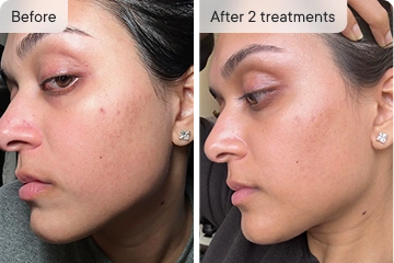 HoMEso Customer before and after results