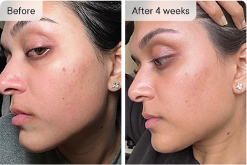 Mona's skin transformation after 4 weeks