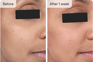 Priya's skin before and after 1 week