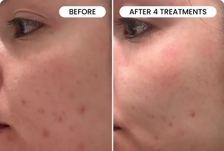Qureo Inj Qure™ Micro-Infusion Facial System