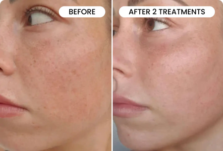 Micro-Infusion System – Qure Skincare