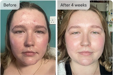 Saskia's skin before and after 4 weeks of treatment.