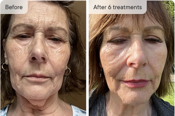 HoMEso Customer before and after results