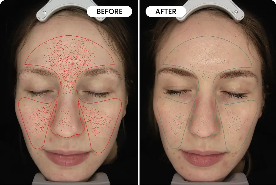 Qureo Inj Qure™ Micro-Infusion Facial System